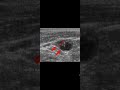 4.Malignent Cervical Lymph Node@Ultrasonography.Awerenes@Cervical Lymph Node disease#Awerenes of All