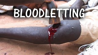 Modern Day Blood-letting in North Africa