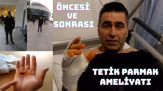 Tetik Parmak Ameliyatı Öncesi Ve Sonrası