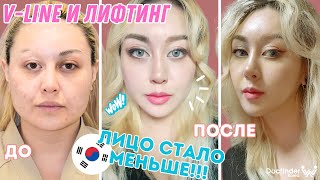 Сделала V-line и Лифтинг в Корее - Как я выгляжу через год? | Операция для уменьшения лица | часть 2