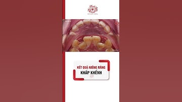 Kết Quả Sau Niềng Răng Khấp Khểnh #niengrang #niengrangmaccai #niengranguytin #shorts