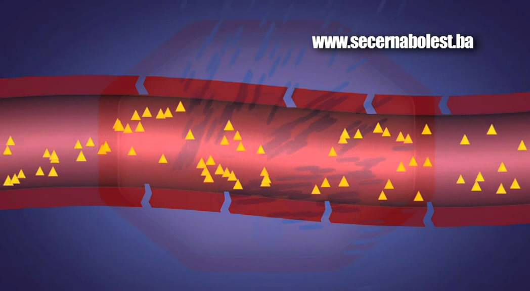 Dijabetes - kako nastaje dijabetes