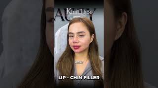 **Lip & Chin Contouring at Cici Beauty – Soft, Balanced Beauty in Hanoi** Lip and chin filler is on