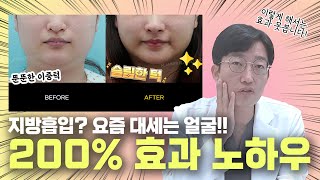 얼굴지방흡입!! 실제 수술장면 보여드림!!궁금하면 클릭!!