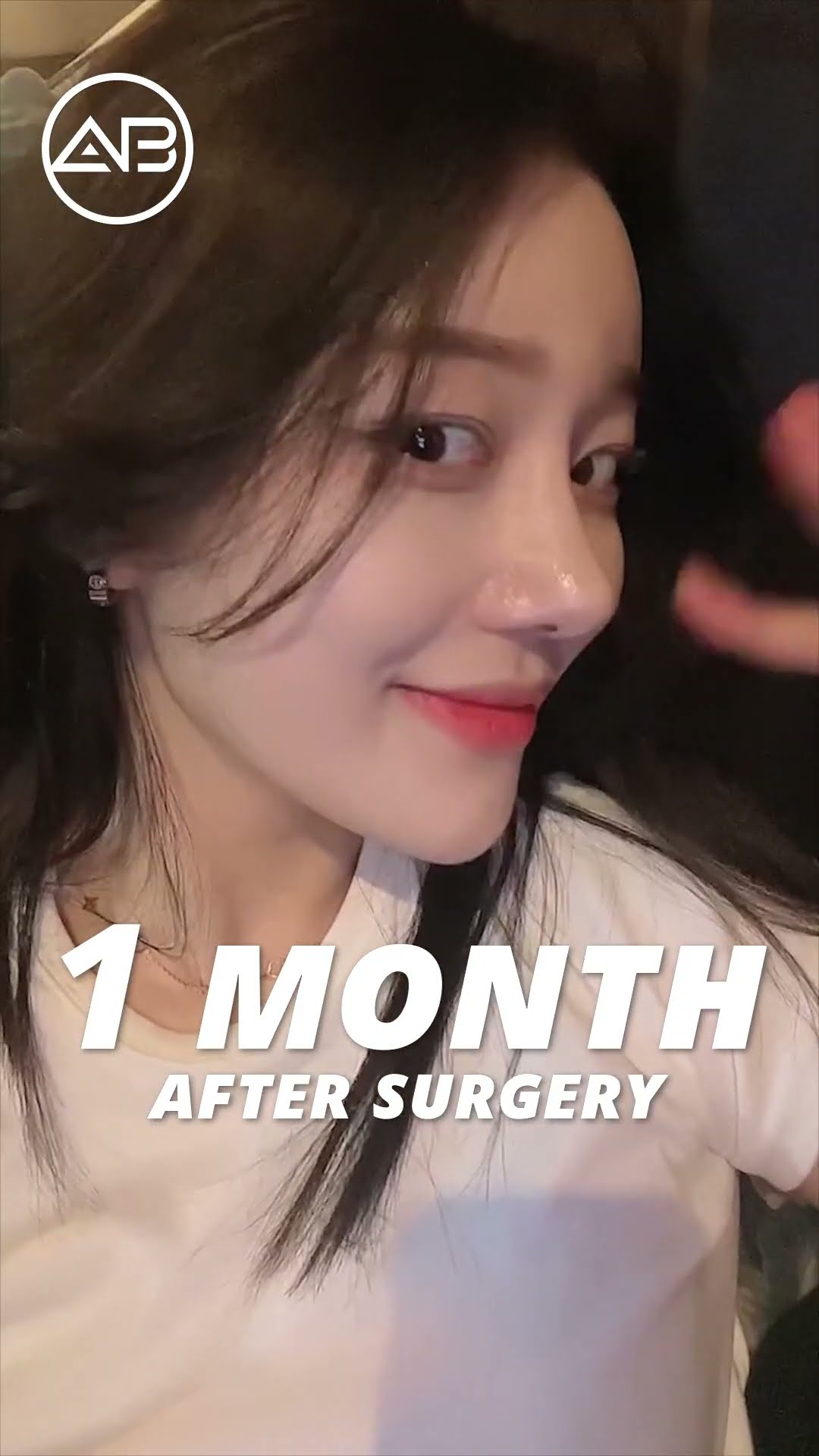 [Plastic surgery in Korea] Revision Rhinoplasty + Wide Nose #abplasticsurgery