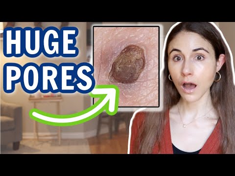 Download HUGE PORES ON THE FACE & HOW TO GET RID OF THEM // Dermatologist @Dr Dray