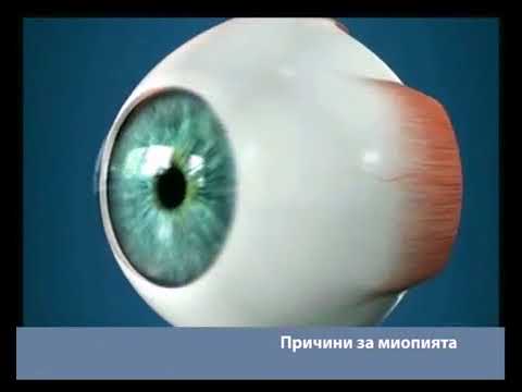 Nearsightedness (Myopia)