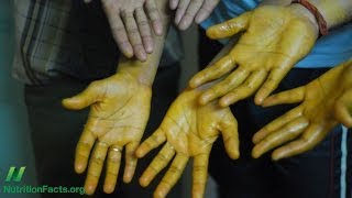 Topical Application of Turmeric Curcumin for Cancer