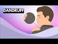 Dandruff, Causes, Signs and Symptoms, Diagnosis and Treatment.