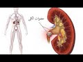 شوف مدمر حصوات واملاح الكلي العبقري 