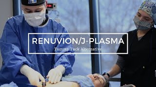 Renuvion/J-Plasma - Tummy Tuck Alternative?