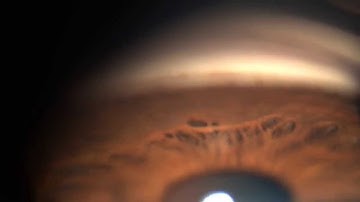 Gonio lens video G2 Volk Lens