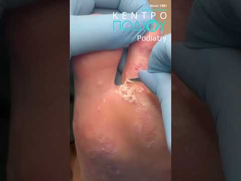 Plantar Wart |Αφαίρεση Μυρμηγκιάς #kentropodiou #κεντροποδιου #podologos #podology #feet #podiatry