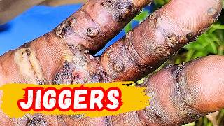Best Way to Treat Jiggers on Hands Without Pain or Scarring