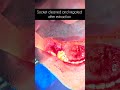 #surgery #teeth #removal #dentist #doctor #clinic #hospital #care #shorts #shortvideo #dental #short