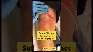 Suture Stitches Removal Process Total Knee Replacement 🔥 टांके धागे वाले निकाले गए ✓