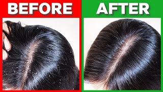 How To Get Rid of Dandruff Fast in 2024