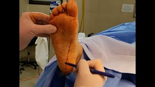 The Change in Subtalar Joint Axis Location With The 'Arch-It' Subtalar Joint Arthroereisis.