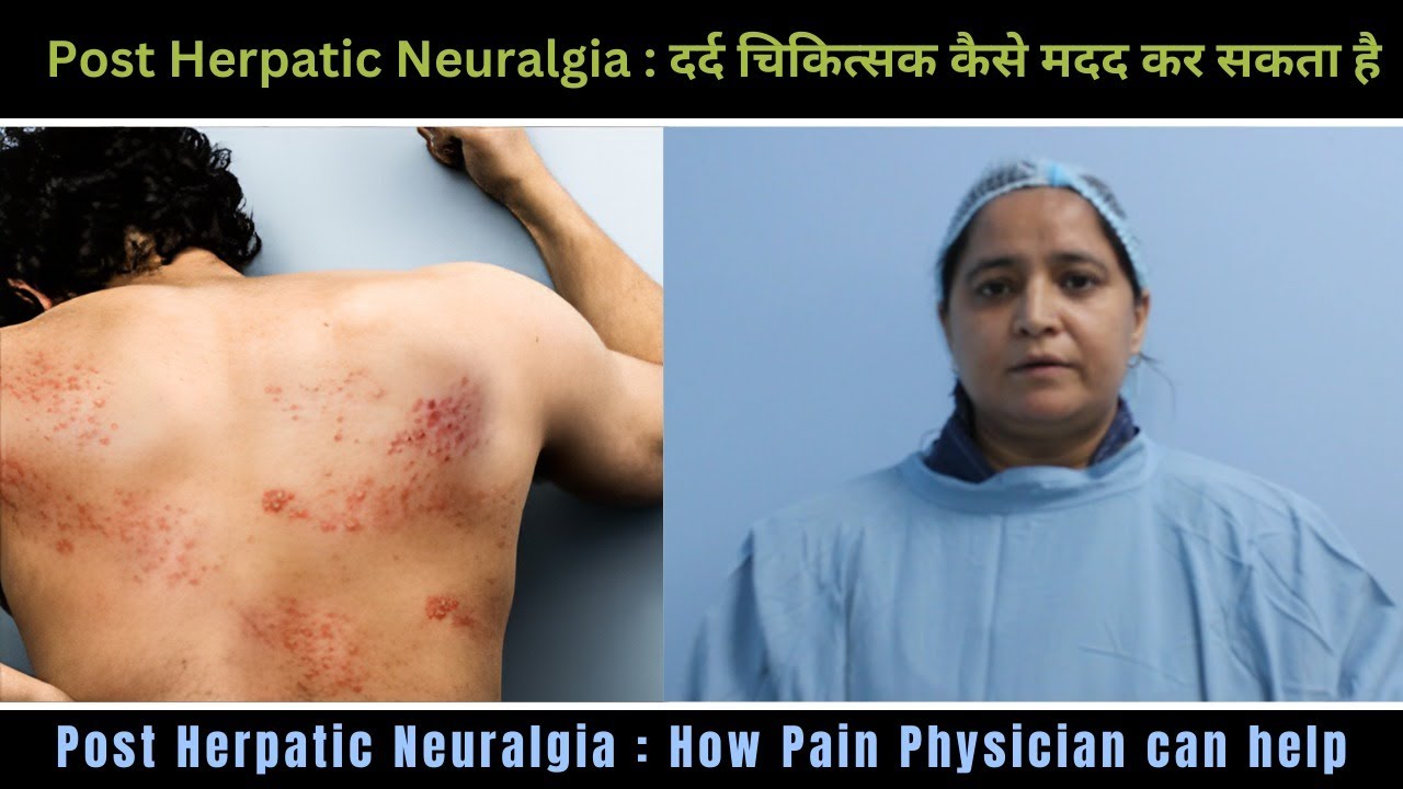 Post Herpetic Neuralgia How Pain Physician Can Help By DR AANCHAL Post Herpetic Neuralgia How Pain Physician Can Help By DR AANCHAL