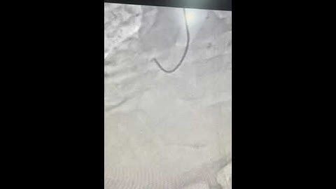 PCI of acute RCA total occlusion