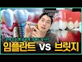 임플란트 vs 브릿지 딱! 정해드립니다