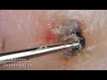 毛掘りneo［Ingrown hair］14