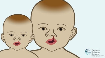 Embryonic development: Cleft lip and/or palate