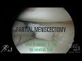 Partial meniscectomy: Video of this meniscus surgery