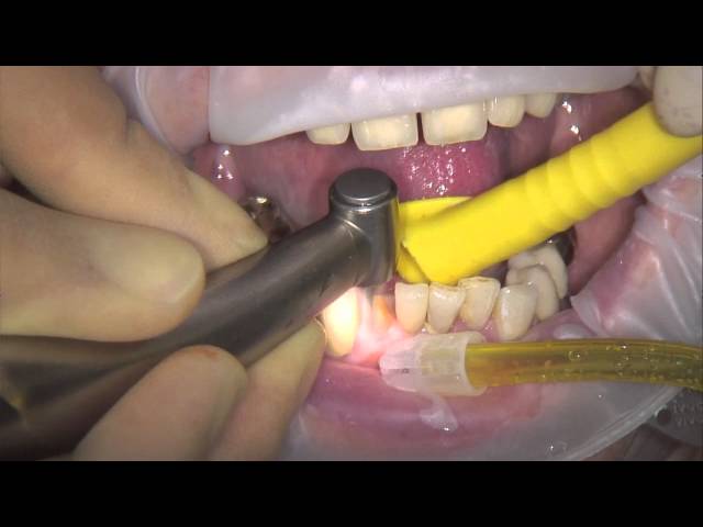 Feuilles fleximeter-strips, jauges d´épaisseur souples, Fourniture dentaire, Equipement dentiste