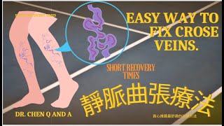 靜脈曲張好困擾怎麼辦？ Treatment by Medication Injection for Varicose Veins