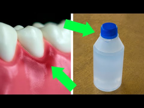 Video: Si të ndaloni gjakderdhjen e mishrave të dhëmbëve, gingivit, periodontit: 11 hapa