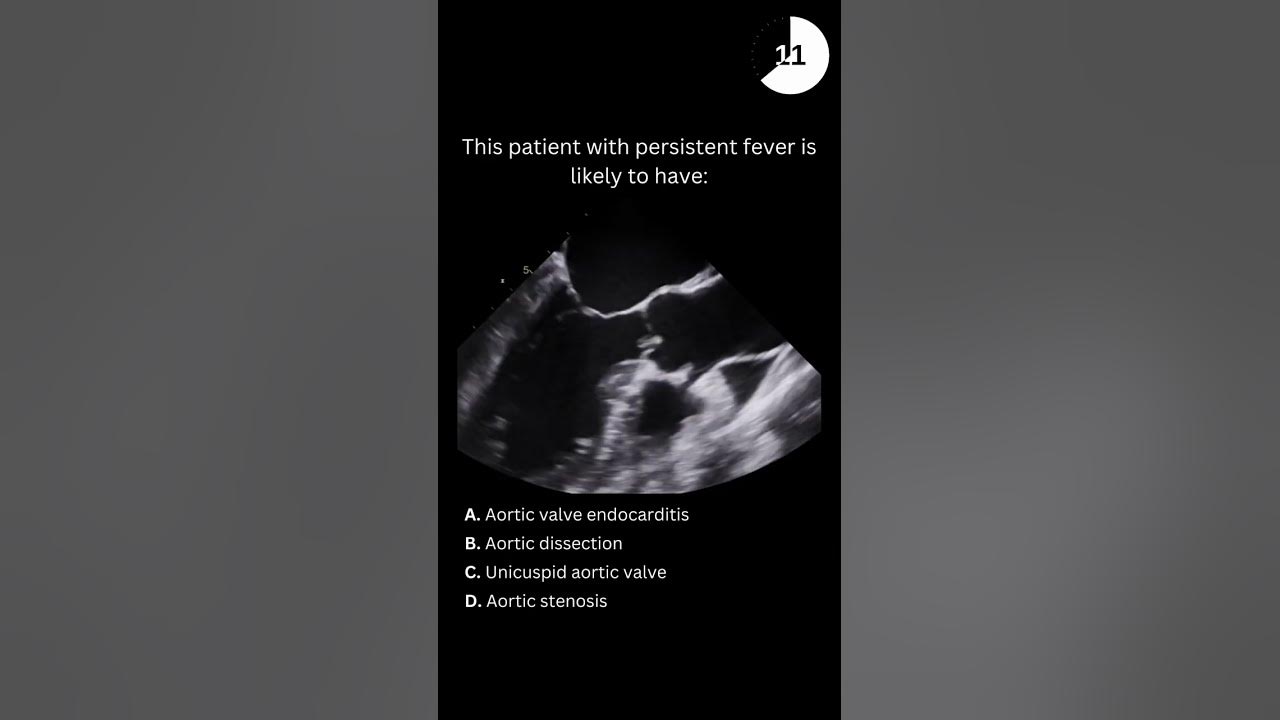 Echocardiography board practice question #23 - YouTube