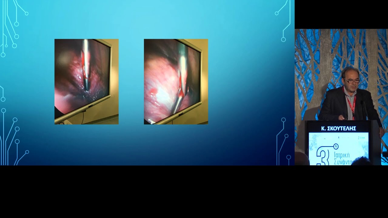 VATS Medical thoracoscopy Σκουτέλης Κ. YouTube
