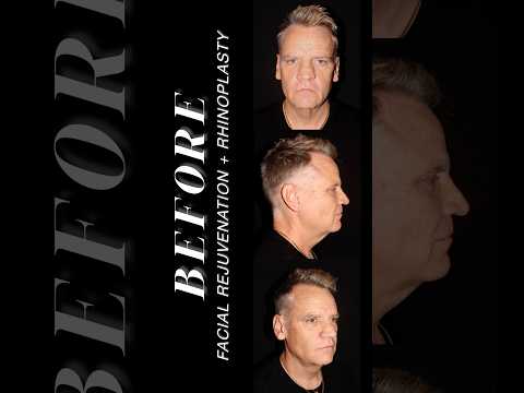 Video thumbnail: Surgery Journey (Facial Rejuvenation + Rhinoplasty) · Paul N. Afrooz, MD