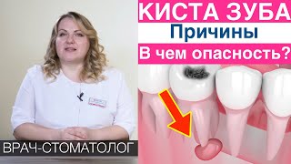 Киста зуба - причины и в чем опасность кисты зуба