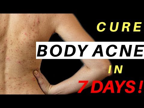  Tips to Get Rid of Body Acne | Body Acne Treatment
