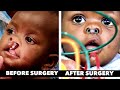 BEFORE & AFTER CLEFT LIP / CLEFT PALATE SURGERY | Dr. Paul