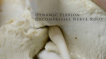 Lumbar Spinal Stenosis LxD Preview Anatomical Update Coming Soon