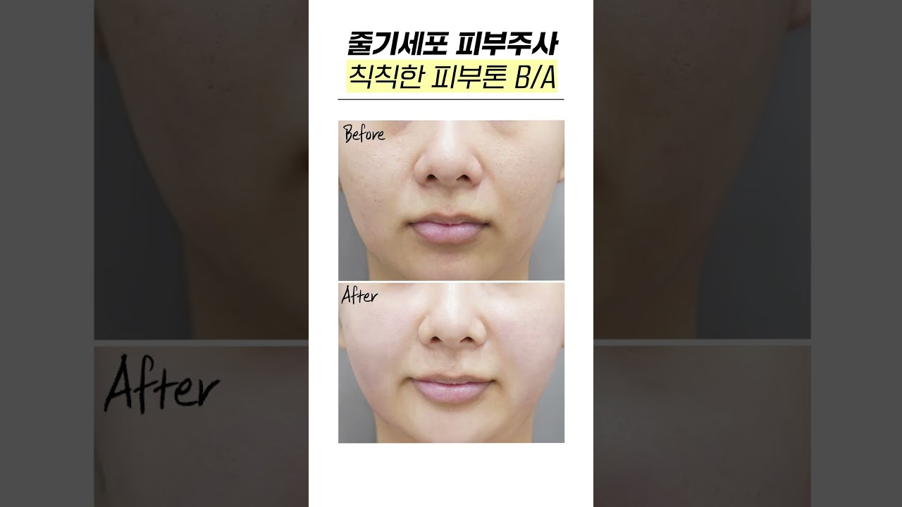 [Риэнжанг Гоо сайхны мэс заслын эмнэлэг] Үүдэл эсийн арьсны тариа #shorts