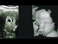 Ultrasound Progression