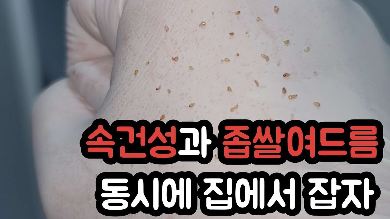 집에서 속건성과 좁쌀여드름 동시에 잡자(feat. 피부관리실 원장의 기초템)