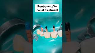 حشو عصب || root canal treatment