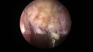 Coblation adenoidectomy in 3.5 yr child part 1