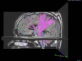 Rsna diffusion tensor image of the brain