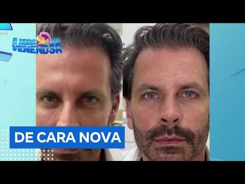 Henri Castelli gets a new facial harmonization and shows the results; see the before and after