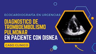 Ecocardiograma En Urgencias Diagnóstico De Tromboembolismo Pulmonar En Un Paciente Con Disnea