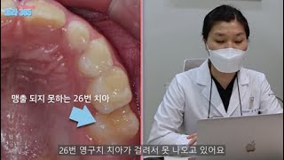 [성장기치아교정] 유치에 걸려서 영구치가 못나와요!