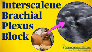Interscalene Brachial Plexus Block