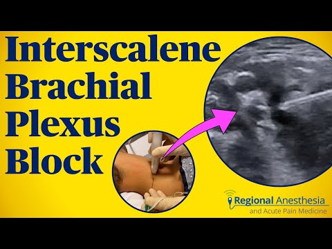 Interscalene Brachial Plexus Block