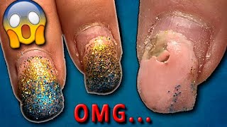 Acne on Nails!😱 Surprise under gel polish.❌Spoiled Nails. Horrible manicure.Transformation.GEL NAILS